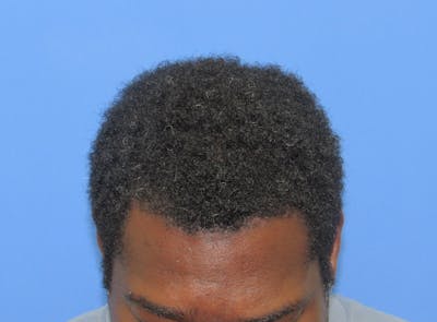 Male Hair Transplant Before & After Gallery - Patient 240822 - Image 2