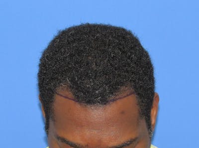 Male Hair Transplant Before & After Gallery - Patient 240822 - Image 1