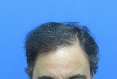 Male Hair Transplant Before & After Gallery - Patient 170111 - Image 2