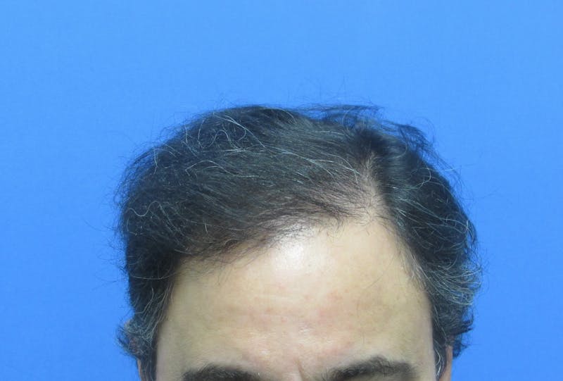 Male Hair Transplant Before & After Gallery - Patient 170111 - Image 2