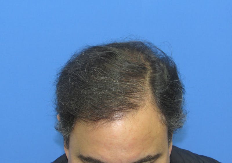 Male Hair Transplant Before & After Gallery - Patient 170111 - Image 4