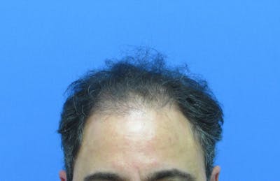 Male Hair Transplant Before & After Gallery - Patient 170111 - Image 1