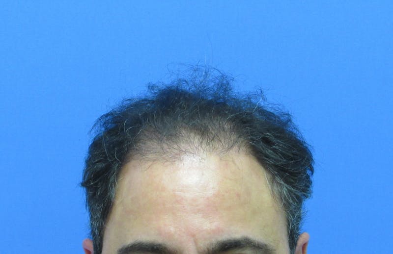 Male Hair Transplant Before & After Gallery - Patient 170111 - Image 1