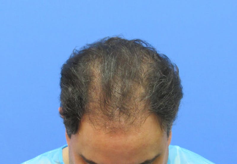 Male Hair Transplant Before & After Gallery - Patient 170111 - Image 3
