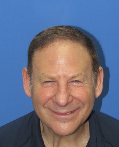 Male Hair Transplant Before & After Gallery - Patient 695810 - Image 2