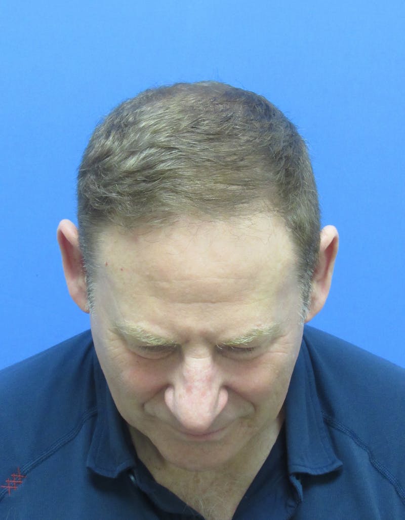 Male Hair Transplant Before & After Gallery - Patient 695810 - Image 4