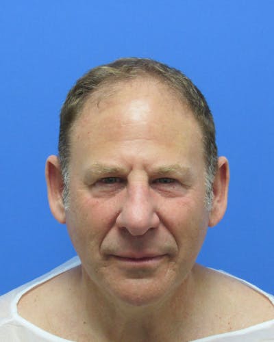 Male Hair Transplant Before & After Gallery - Patient 695810 - Image 1