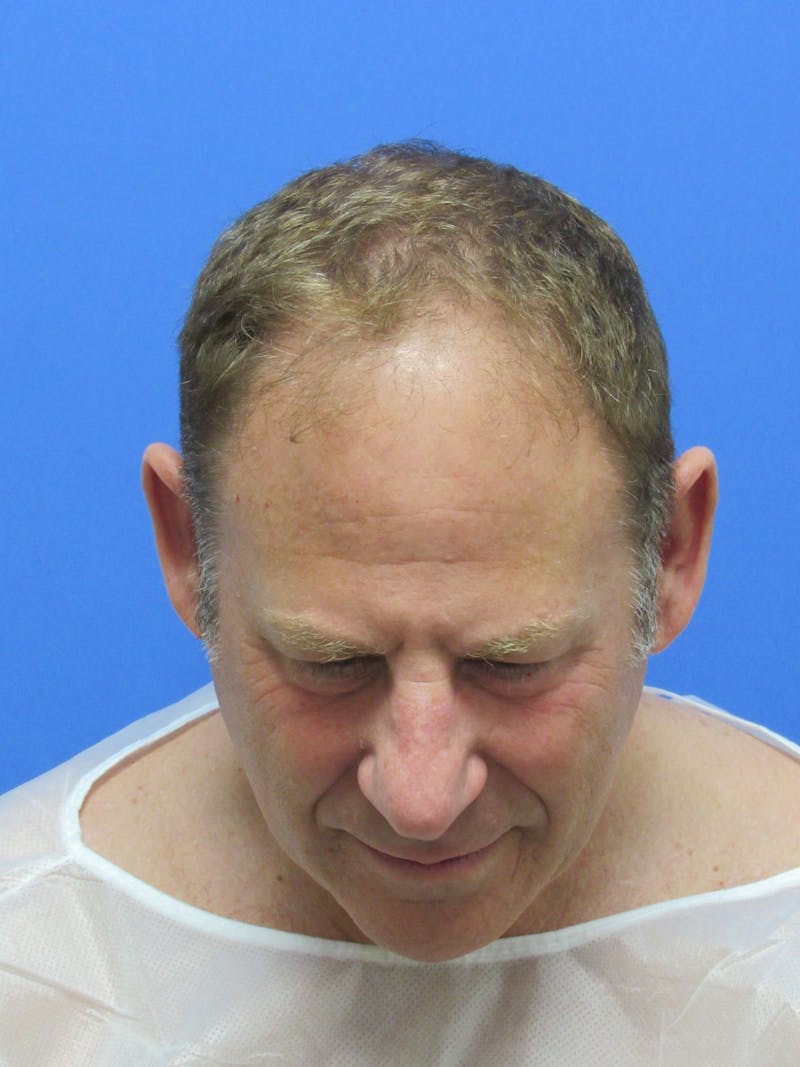 Male Hair Transplant Before & After Gallery - Patient 695810 - Image 3