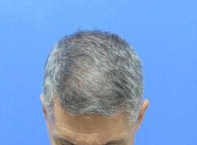 Male Hair Transplant Before & After Gallery - Patient 326664 - Image 2
