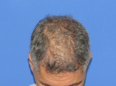 Male Hair Transplant Before & After Gallery - Patient 326664 - Image 1