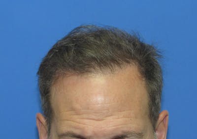 Male Hair Transplant Before & After Gallery - Patient 135211 - Image 2