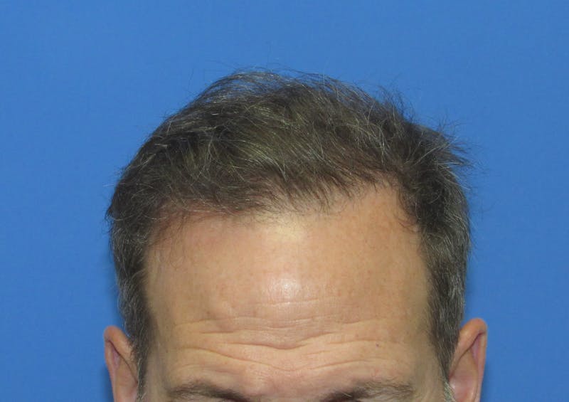 Male Hair Transplant Before & After Gallery - Patient 135211 - Image 2