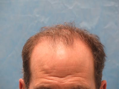 Male Hair Transplant Before & After Gallery - Patient 135211 - Image 1