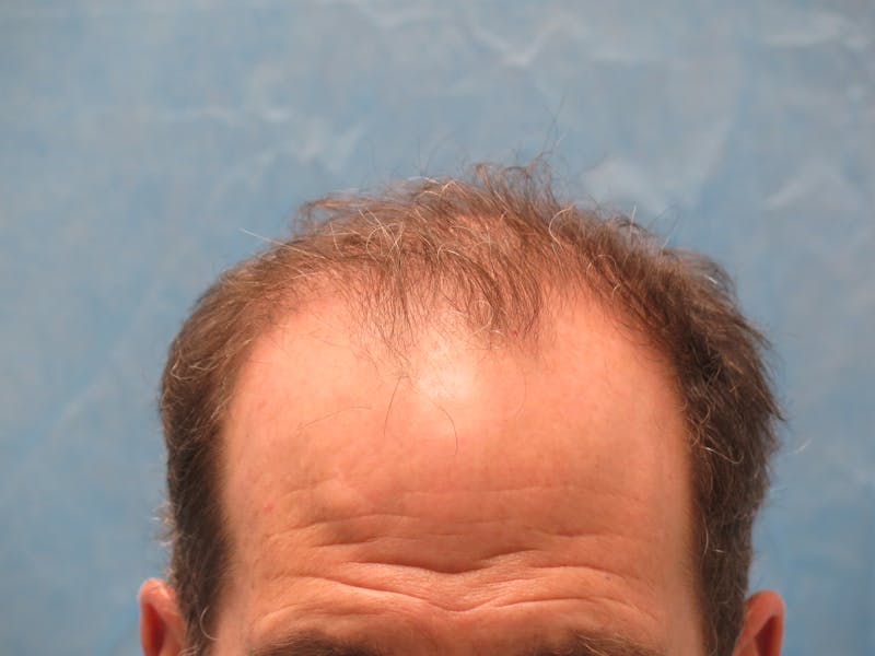 Male Hair Transplant Before & After Gallery - Patient 135211 - Image 1