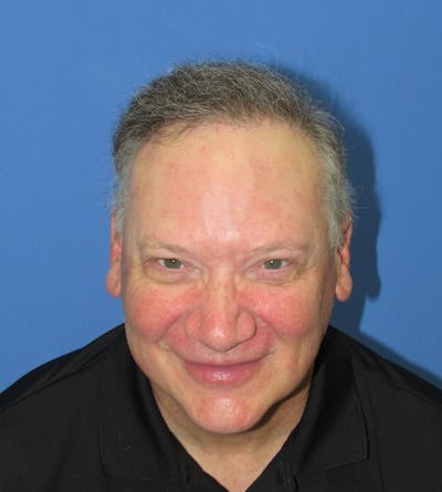 Male Hair Transplant Before & After Gallery - Patient 172745 - Image 2