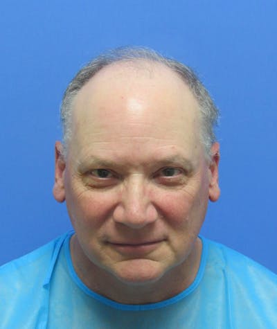Male Hair Transplant Before & After Gallery - Patient 172745 - Image 1