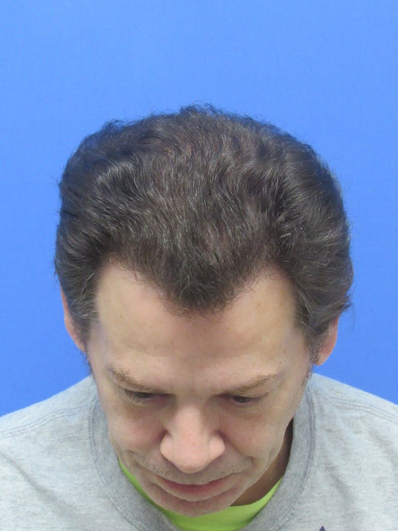 Male Hair Transplant Before & After Gallery - Patient 316468 - Image 4
