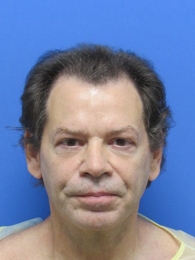 Male Hair Transplant Before & After Gallery - Patient 316468 - Image 1