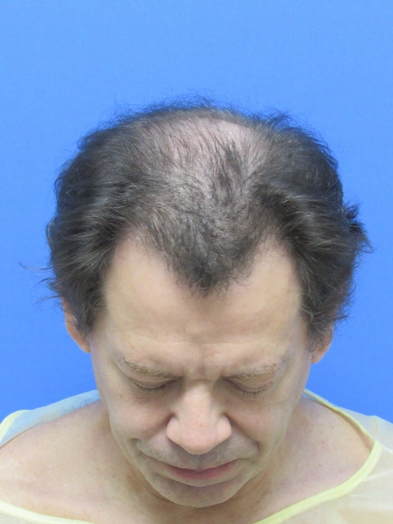 Male Hair Transplant Before & After Gallery - Patient 316468 - Image 3