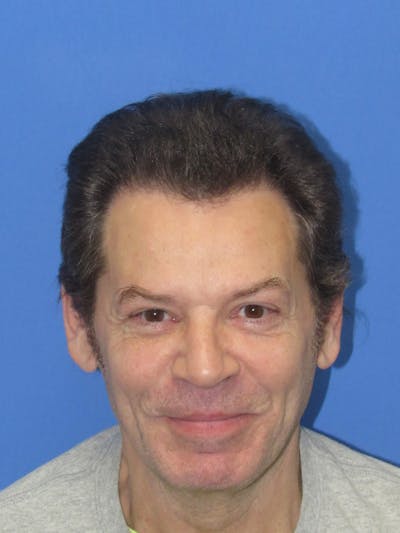 Male Hair Transplant Before & After Gallery - Patient 316468 - Image 2