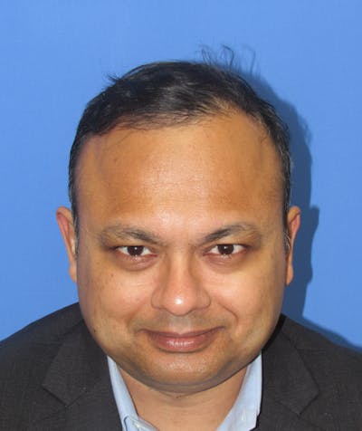 Male Hair Transplant Before & After Gallery - Patient 130643 - Image 2