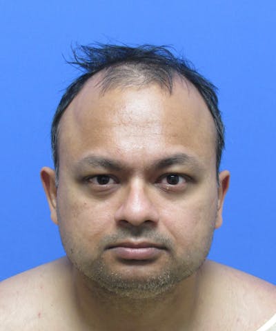 Male Hair Transplant Before & After Gallery - Patient 130643 - Image 1