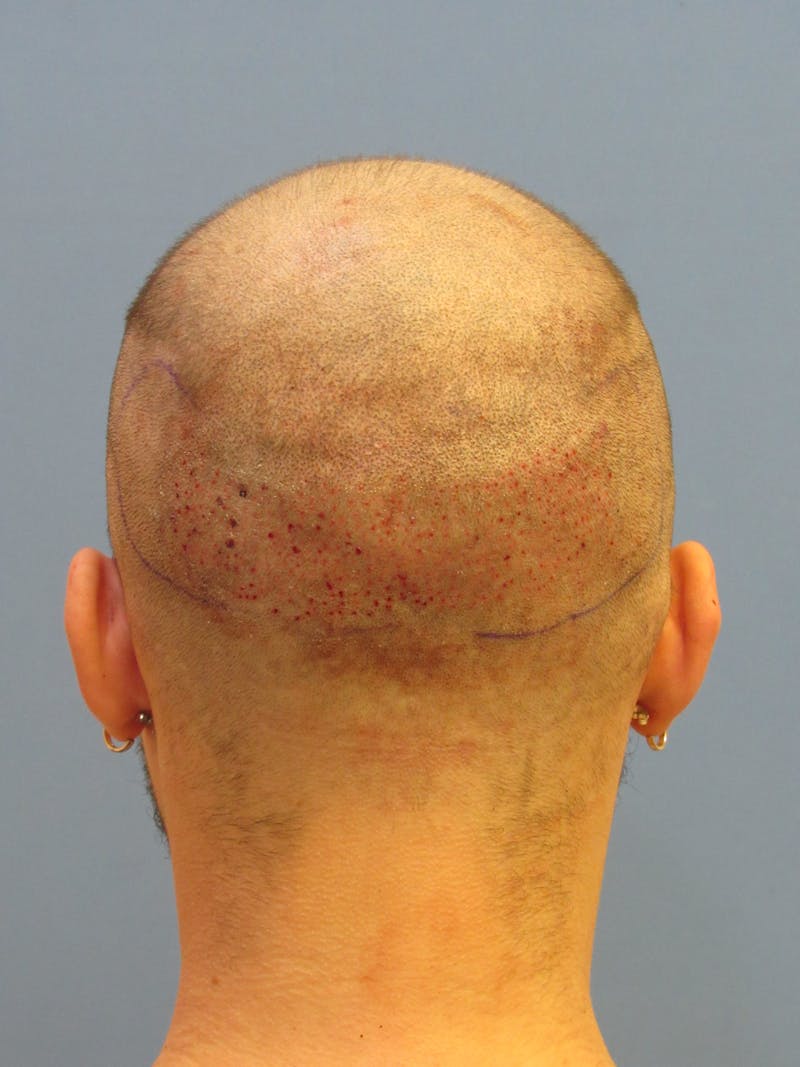 Facial Hair Transplant Before & After Gallery - Patient 237160 - Image 3