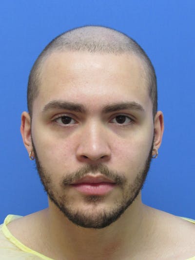 Facial Hair Transplant Before & After Gallery - Patient 237160 - Image 1