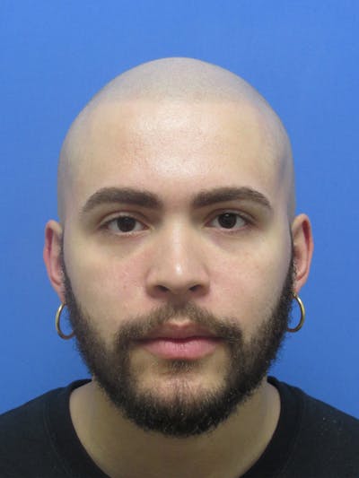 Facial Hair Transplant Before & After Gallery - Patient 237160 - Image 2