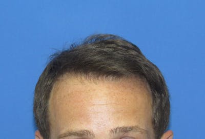 Male Hair Transplant Before & After Gallery - Patient 221303 - Image 2