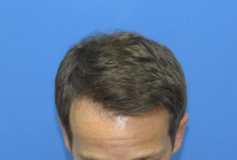 Male Hair Transplant Before & After Gallery - Patient 221303 - Image 4