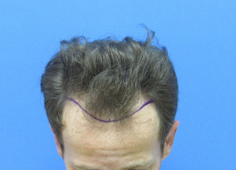 Male Hair Transplant Before & After Gallery - Patient 221303 - Image 3