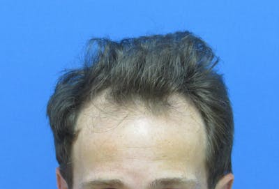 Male Hair Transplant Before & After Gallery - Patient 221303 - Image 1