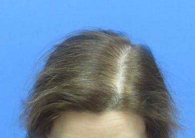 Female Hair Transplant Before & After Gallery - Patient 255660 - Image 2