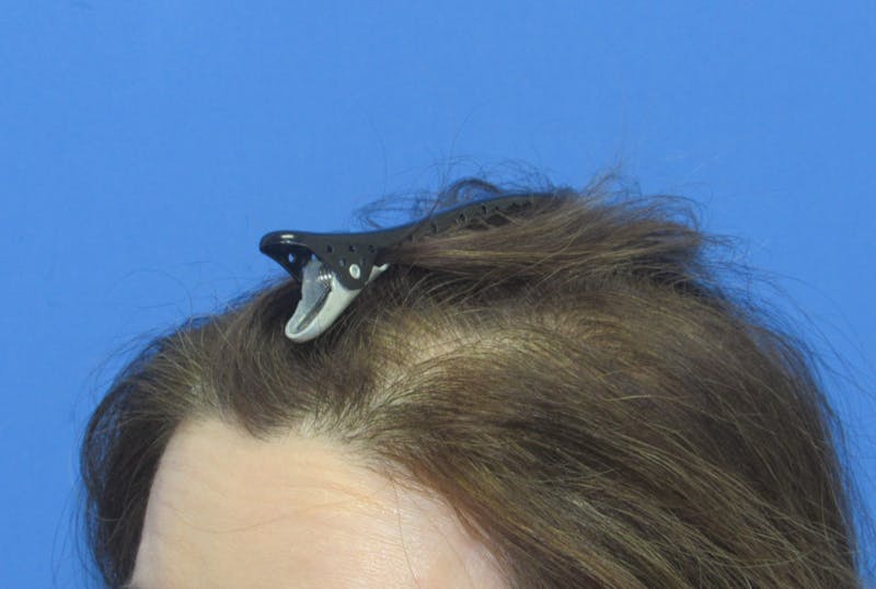 Female Hair Transplant Before & After Gallery - Patient 255660 - Image 4