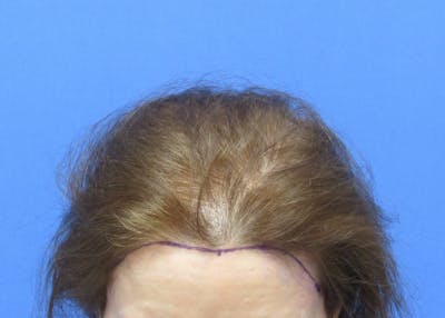 Female Hair Transplant Before & After Gallery - Patient 255660 - Image 1