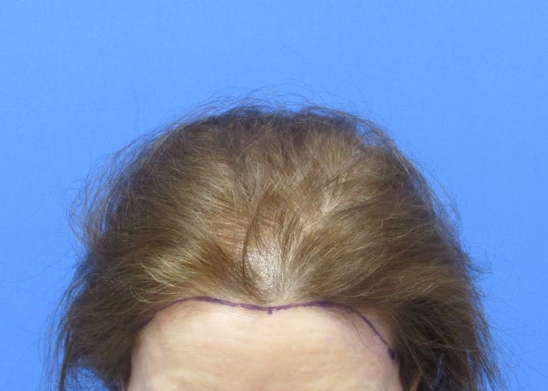 Female Hair Transplant Before & After Gallery - Patient 255660 - Image 1