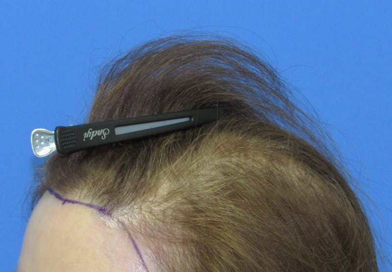 Female Hair Transplant Before & After Gallery - Patient 255660 - Image 3