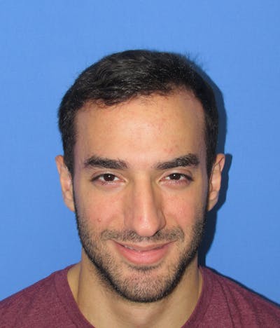 Male Hair Transplant Before & After Gallery - Patient 279653 - Image 2