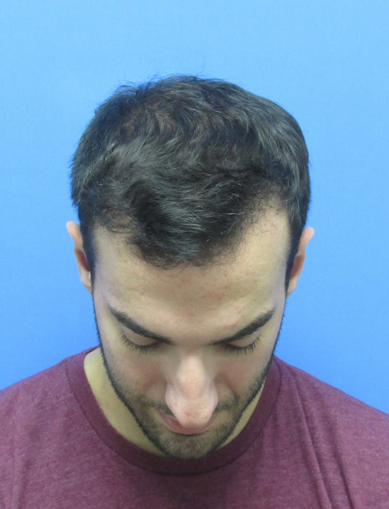 Male Hair Transplant Before & After Gallery - Patient 279653 - Image 4