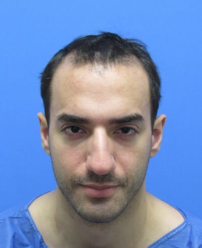 Male Hair Transplant Before & After Gallery - Patient 279653 - Image 1