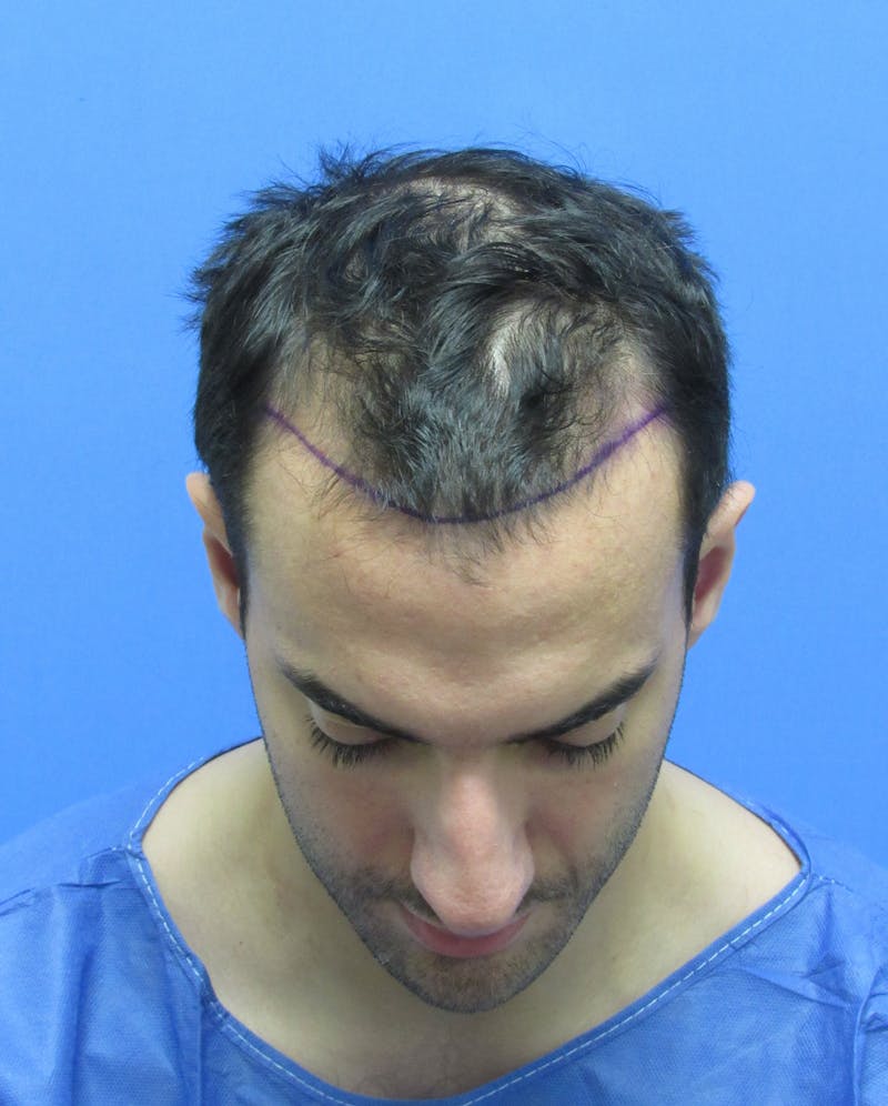 Male Hair Transplant Before & After Gallery - Patient 279653 - Image 3