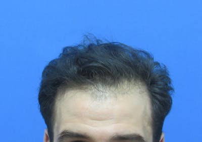 Male Hair Transplant Before & After Gallery - Patient 580923 - Image 2