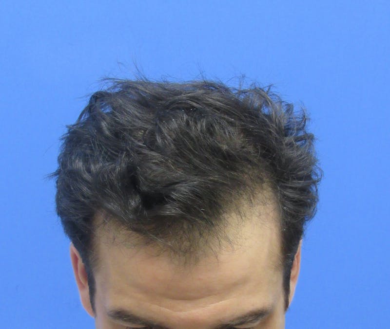 Male Hair Transplant Before & After Gallery - Patient 580923 - Image 4