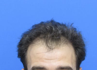 Male Hair Transplant Before & After Gallery - Patient 580923 - Image 1