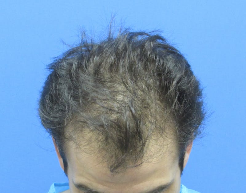 Male Hair Transplant Before & After Gallery - Patient 580923 - Image 3