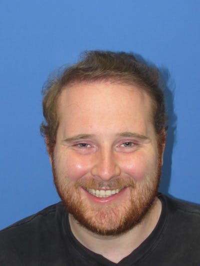 Male Hair Transplant Before & After Gallery - Patient 253620 - Image 2