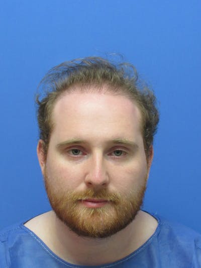 Male Hair Transplant Before & After Gallery - Patient 253620 - Image 1