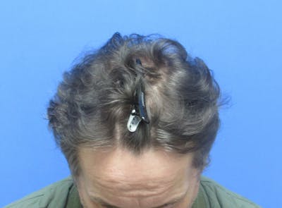 Male Hair Transplant Before & After Gallery - Patient 215895 - Image 1