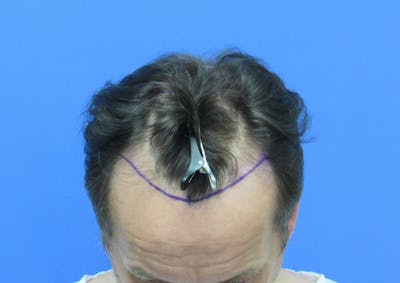 Male Hair Transplant Before & After Gallery - Patient 215895 - Image 2